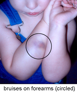 Bruises-on-Forearms