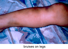 Bruises-on-Legs