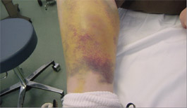 Calf-Bleed