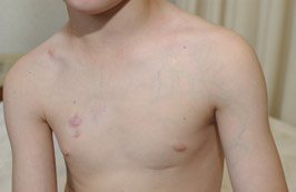 Dilated-Chest-Vessels-from-a-Port-Thrombosis
