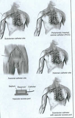 External CVC Insertion