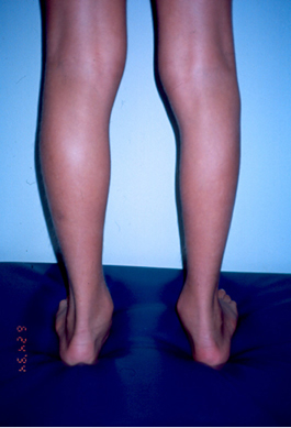 Gastrocnemius-Muscle-Bleed