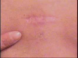 Healed-Port-Exit-Site