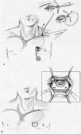 Implantable-Port-Insertion