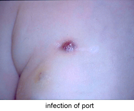 Infection-of-Port