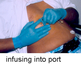 Infusing-into-Port
