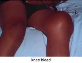 Knee-Bleed-1