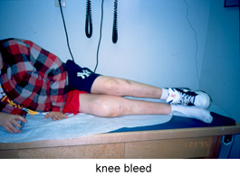 Knee-Bleed-3