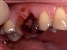 Liver-Clot