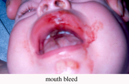 Mouth-Bleed