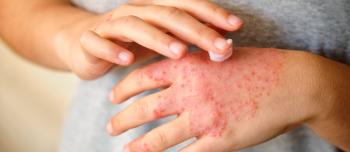 Persons hand with a rash