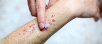 A person pointing at their arm with purple spots